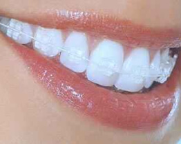 clear-braces