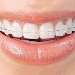 Clear-Braces-mBrace-Frisco-Orthodontics 300px