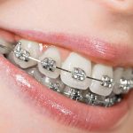 Metal-Braces-Frisco-Orthodontics 300px